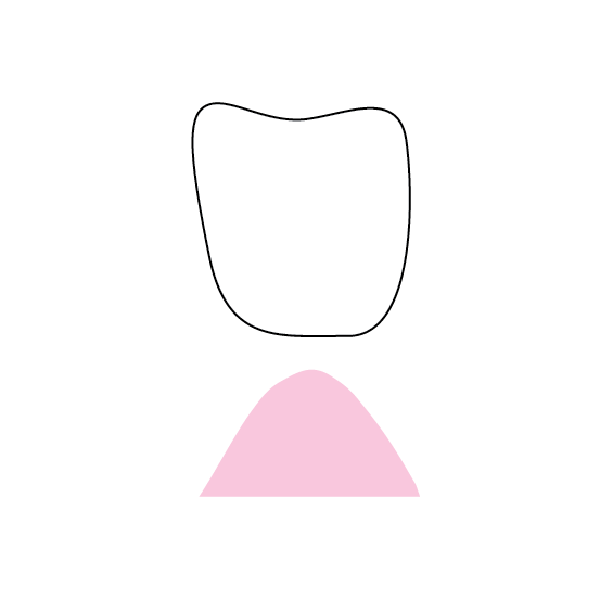 Pontic Design 1