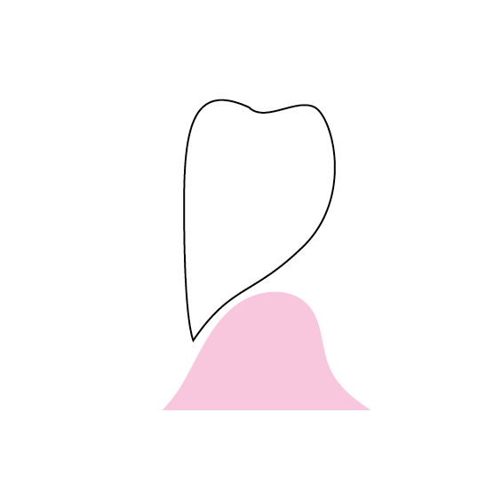 Pontic Design 3
