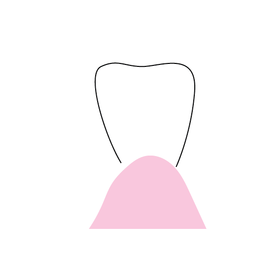 Pontic Design 4